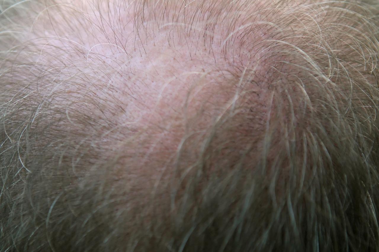 chute de cheveux alopecie